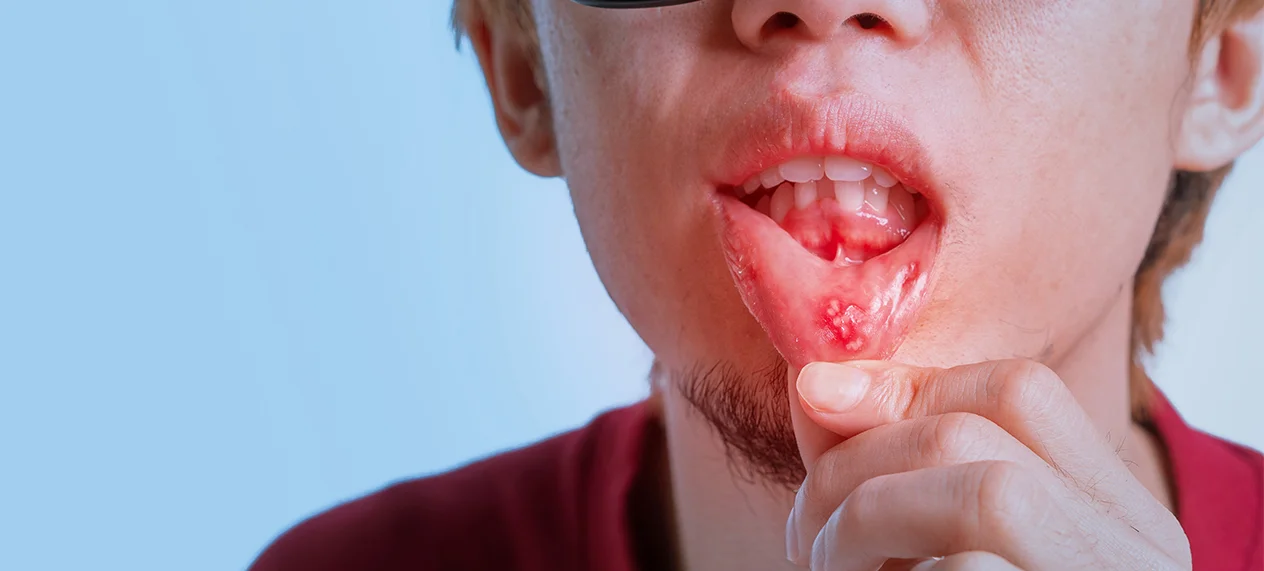 Oral Cancer: Myths vs. Facts – Early Detection and Prevention Tips